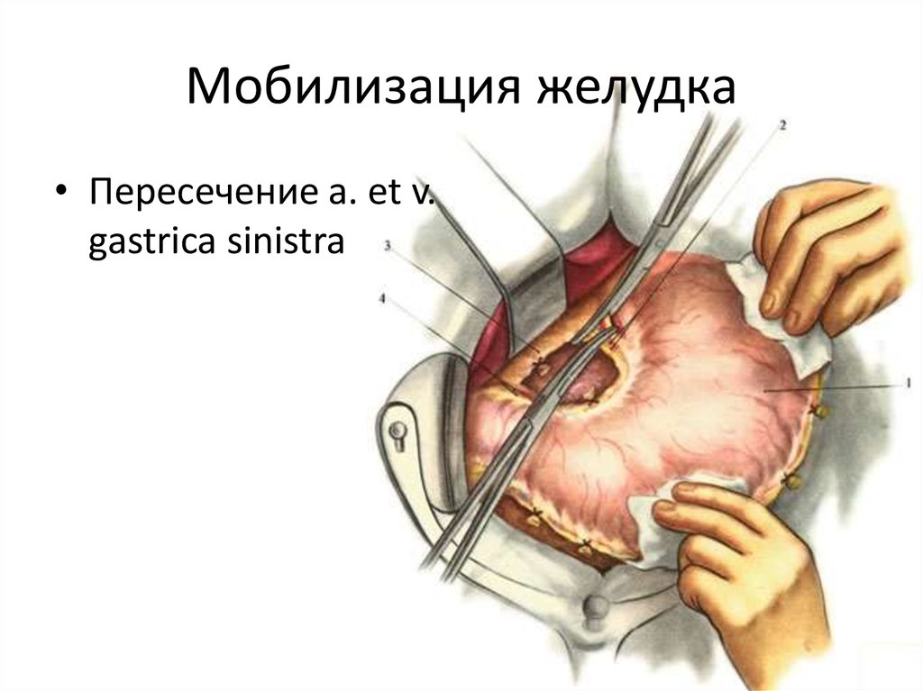 Продольная резекция желудка фото