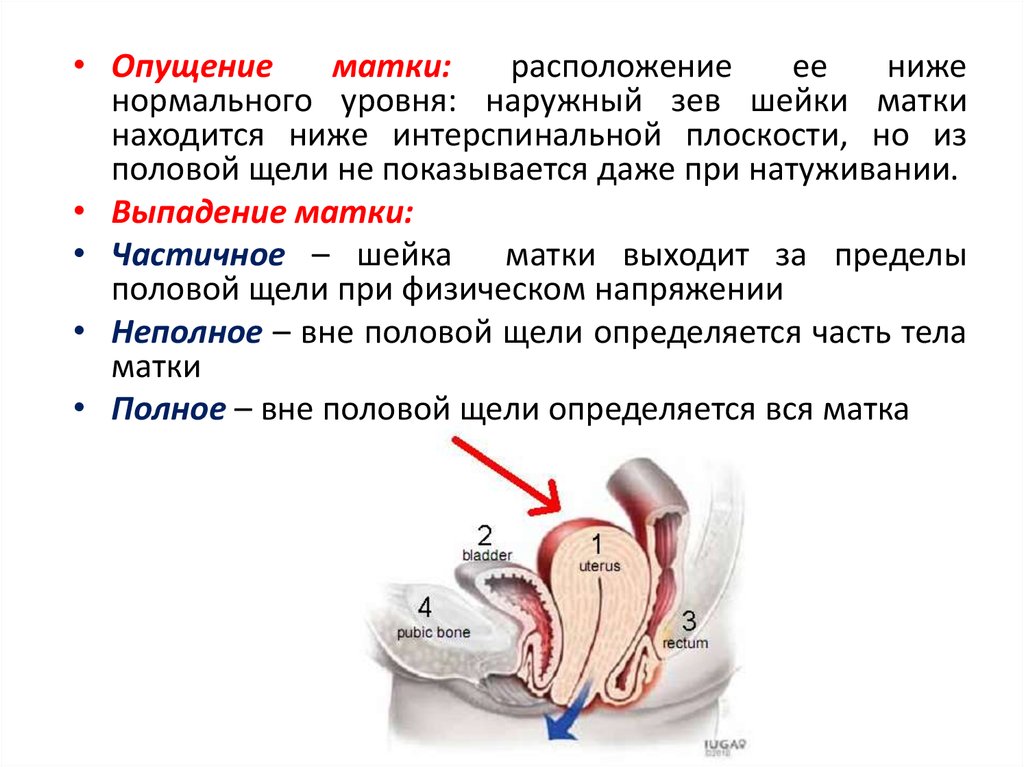 Опущение и выпадение матки презентация