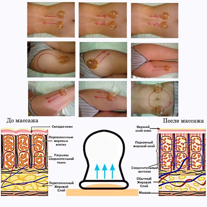 Массаж вакуумными банками живота для похудения