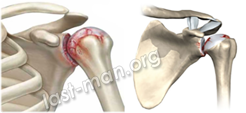 Артроз плечевого сустава