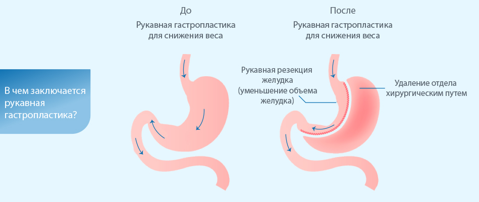 Резекция Желудка Для Похудения Цена В Новосибирске