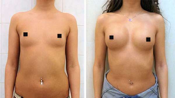 Результат операции по липофилингу груди 