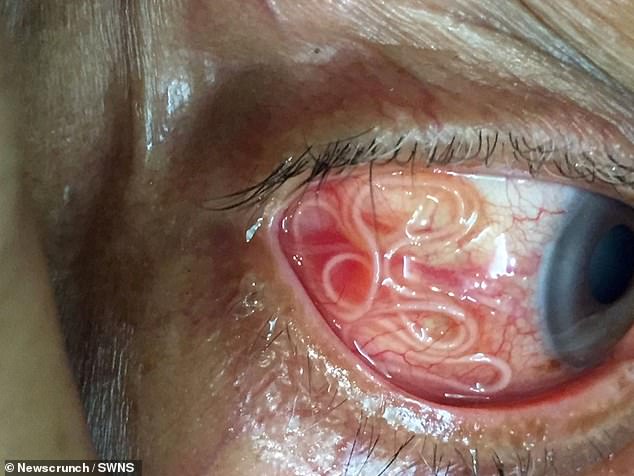 The unnamed patient, from India, complained of both pain and itching in his eyes and decided to seek medical help (pictured: the worm in the man