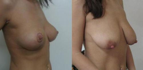 Ужасная грудь после кормления. Грудь до и после родов –фотографии