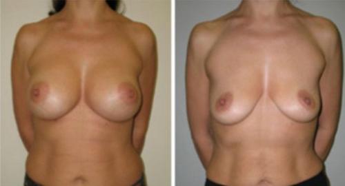 Ужасная грудь после кормления. Грудь до и после родов –фотографии