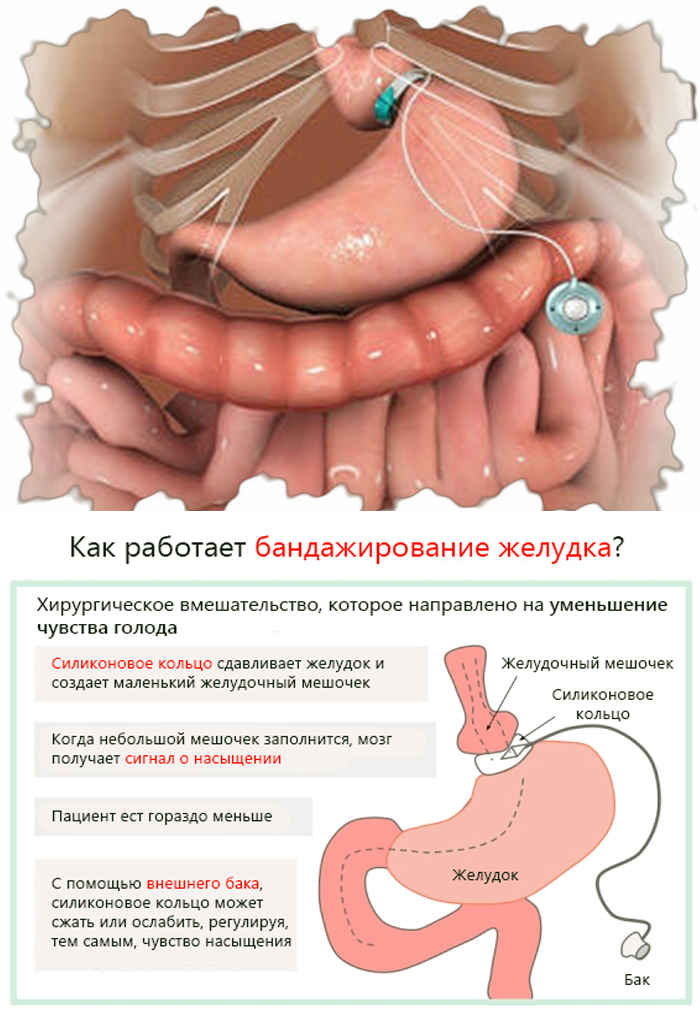 Кодирование от ожирения.