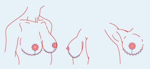 Упражнения, чтобы подтянуть обвисшую грудь. Отвисшая грудь (мастоптоз): стадии, как бороться, как избежать обвисания груди