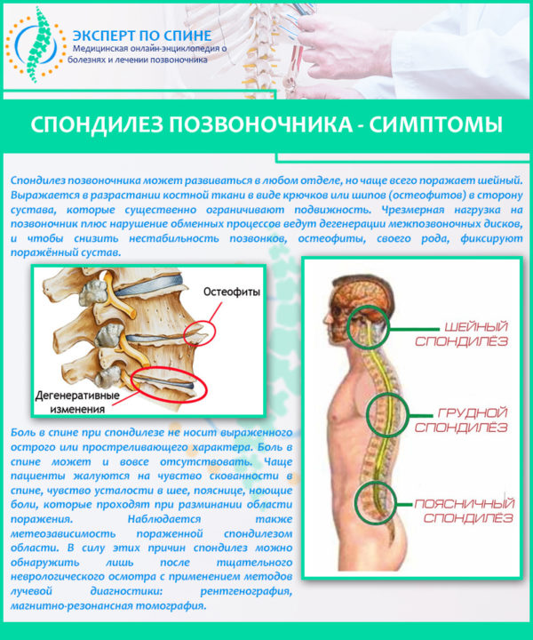 Симптомы спондилеза позвоночника