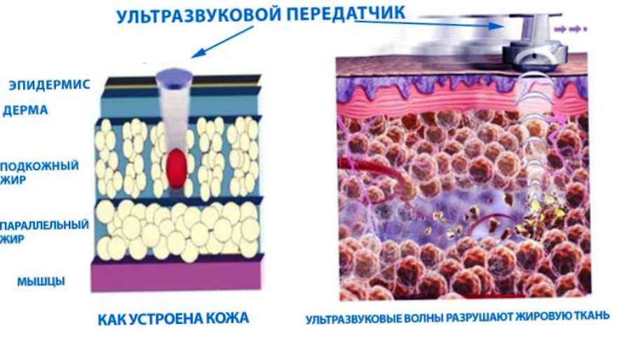 Ультразвуковая кавитация, как это работает